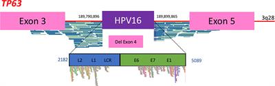 Pathology of HPV-Associated Head and Neck Carcinomas: Recent Data and Perspectives for the Development of Specific Tumor Markers